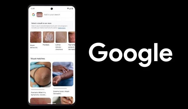 Dibantu teknologi AI, Google Lens bisa deteksi penyakit kulit